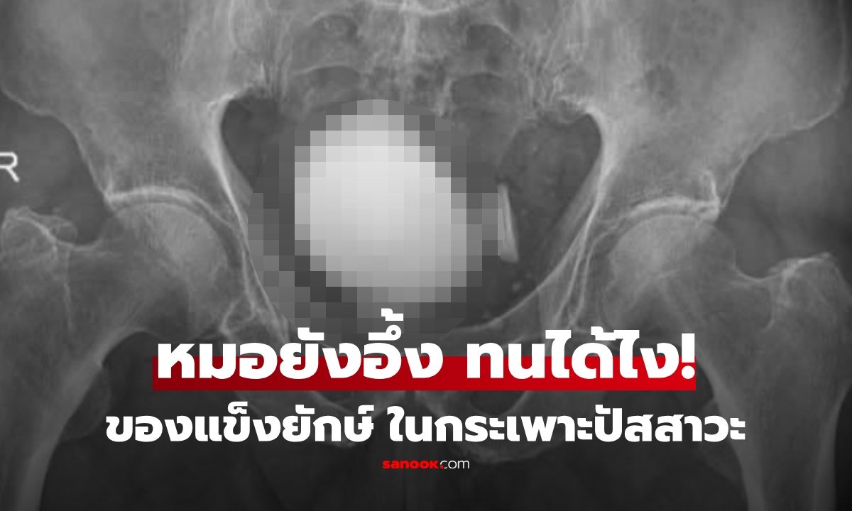 แพทย์ผ่าตัดนิ่วยักษ์หนัก 420 กรัม ออกจากกระเพาะปัสสาวะชายวัย 86 ปี