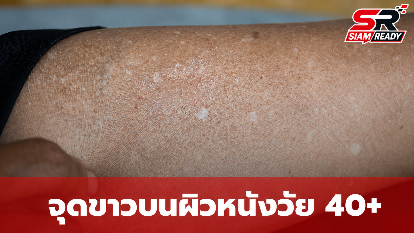 ไขข้อสงสัย 'จุดขาว' บนผิวหนังวัย 40+ คืออะไร? หมอเผยไม่ใช่โรคด่างขาว